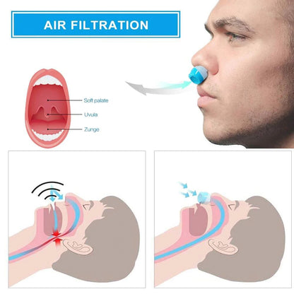 Anti-Snoring Device | Tubeless, maskless micro-CPAP